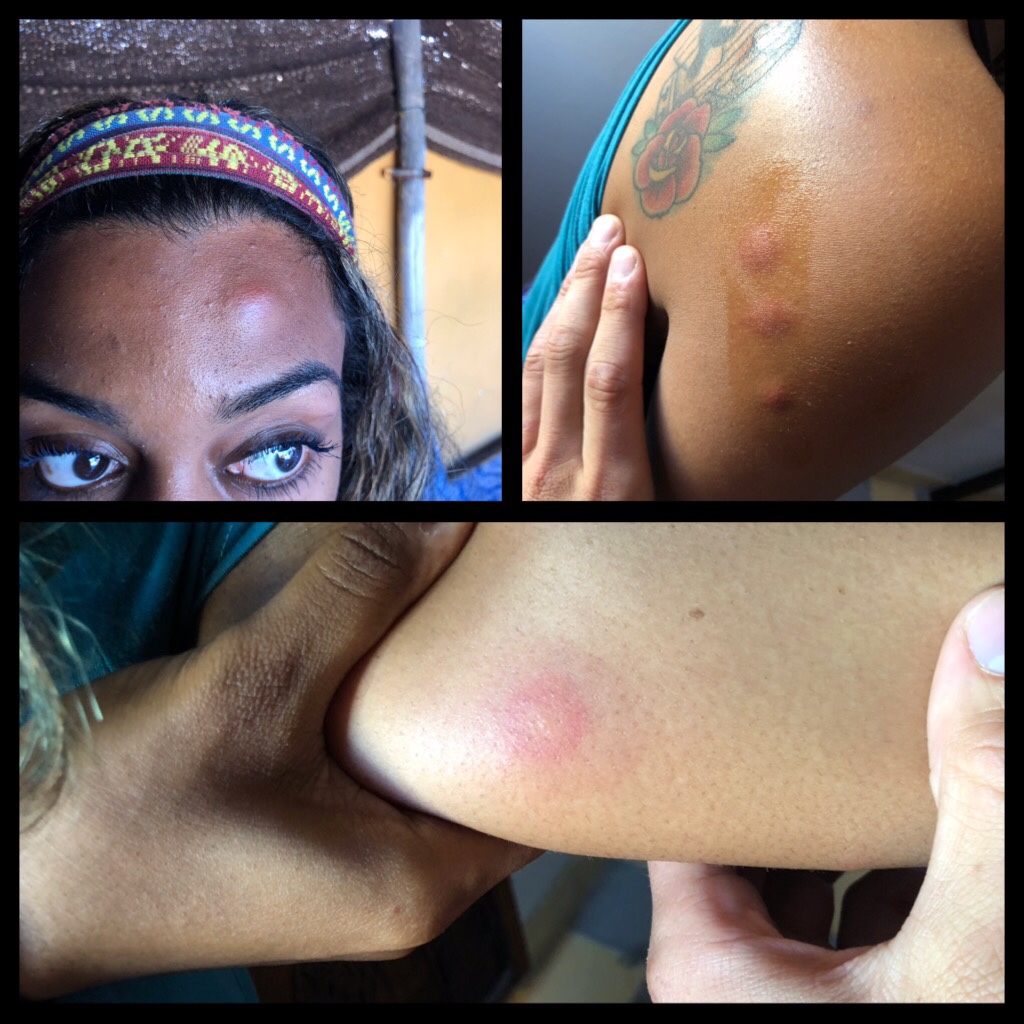 Bed bug bites on a world traveling backpacker in Morocco