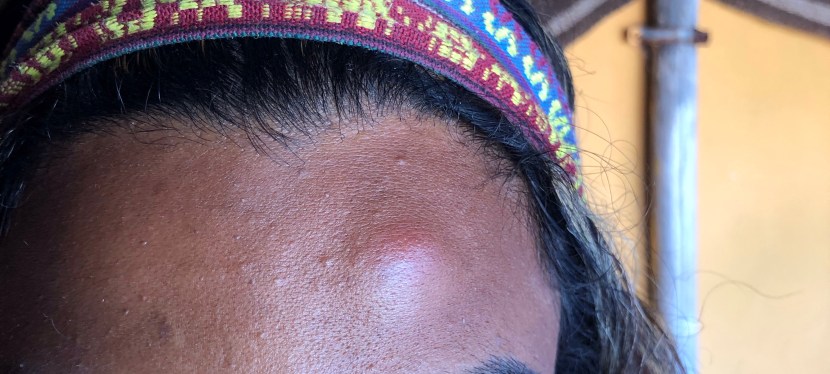 The Bed Bug Chronicles: Part One – Morocco’s Dirty Little&nbsp;Secret
