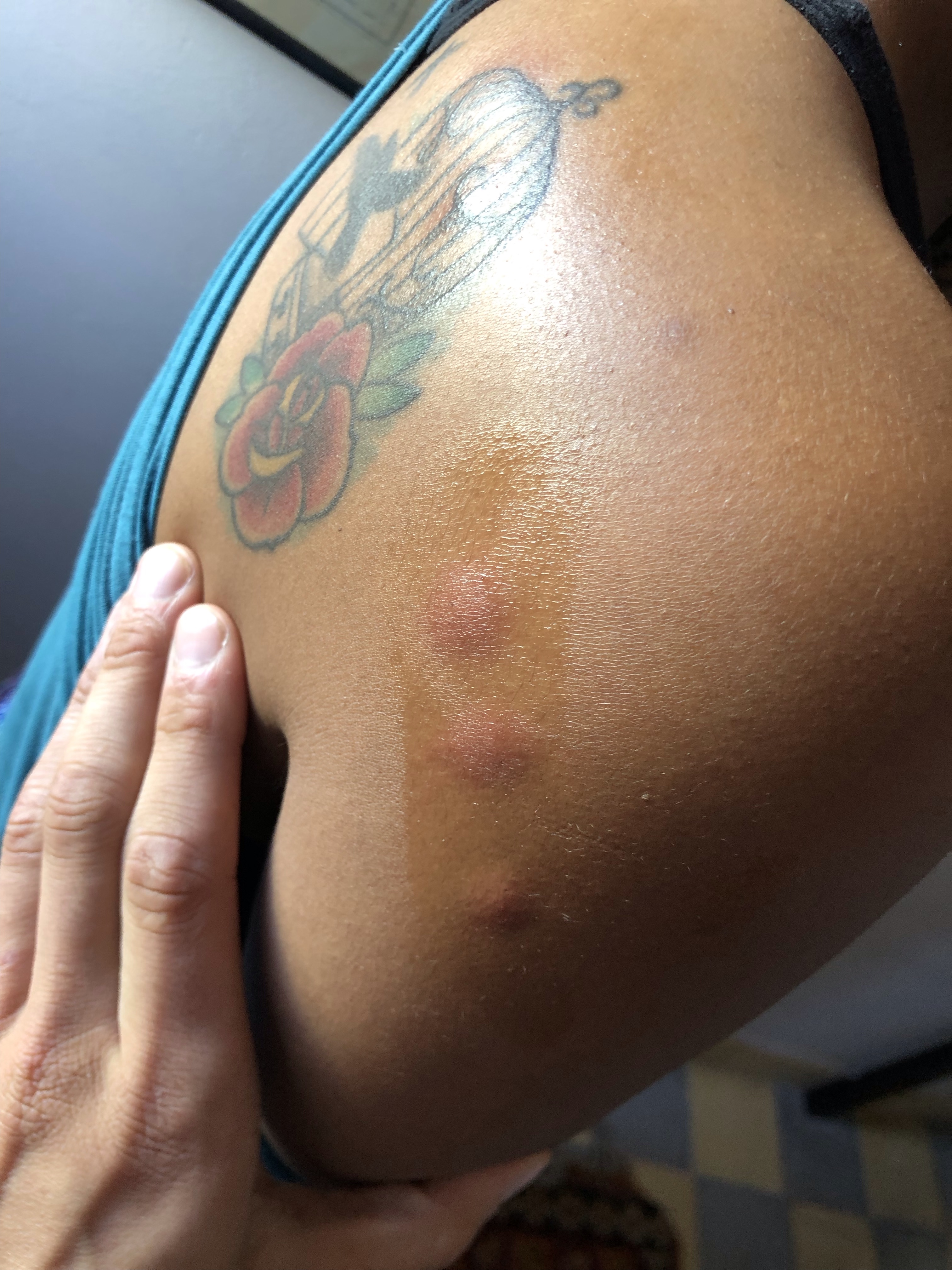 A close up of Amanda’s shoulder with three bug bites in a row. 