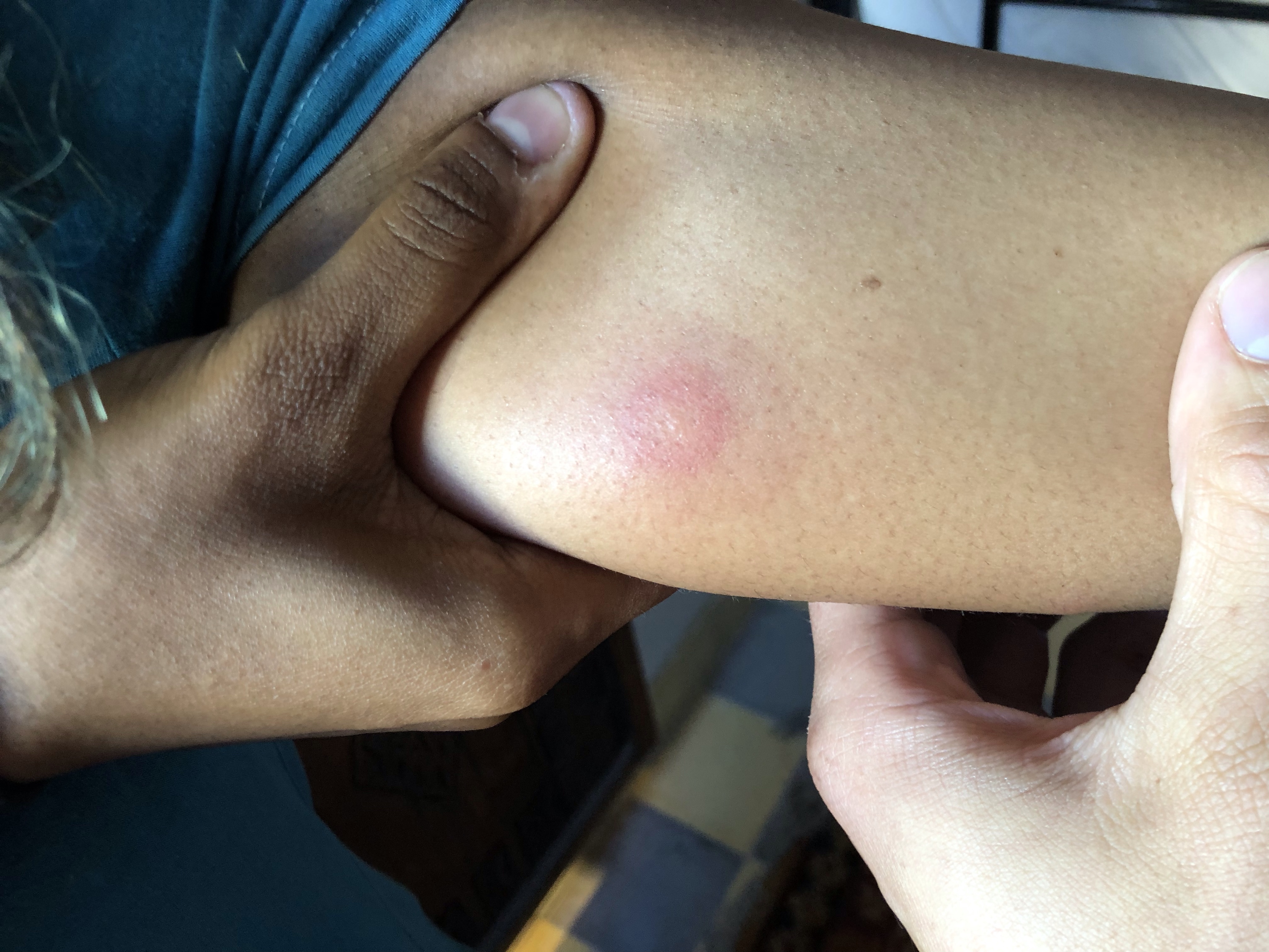 Close up of red bite with a red ring around it on the inside of Amanda’s arm. 