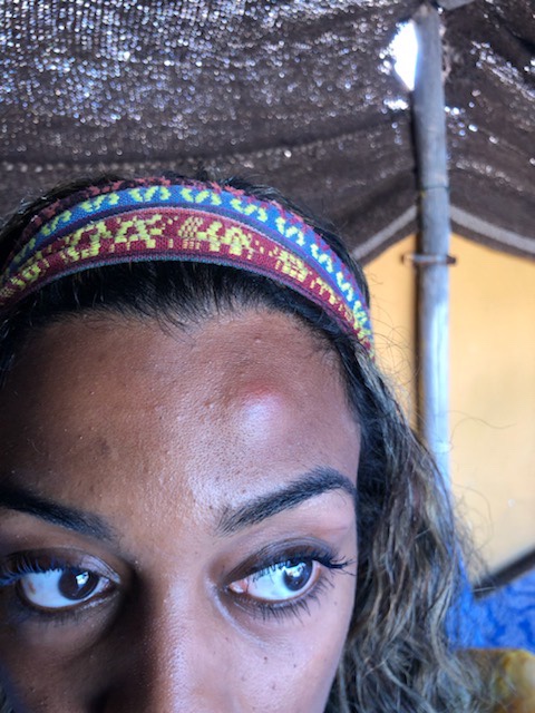 A close up of Amanda’s face with a  giant swollen red bump on the left side of her forehead just above her eyebrow. 